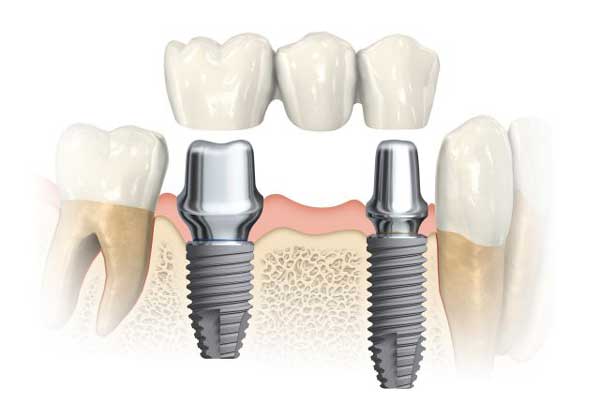 Impianti dentali ad Alzate Brianza | Implantologia