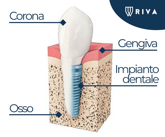 Studio dentistico Riva| Figino Serenza| Alzate Brianza| implantologia| impianto dentale carico immediato