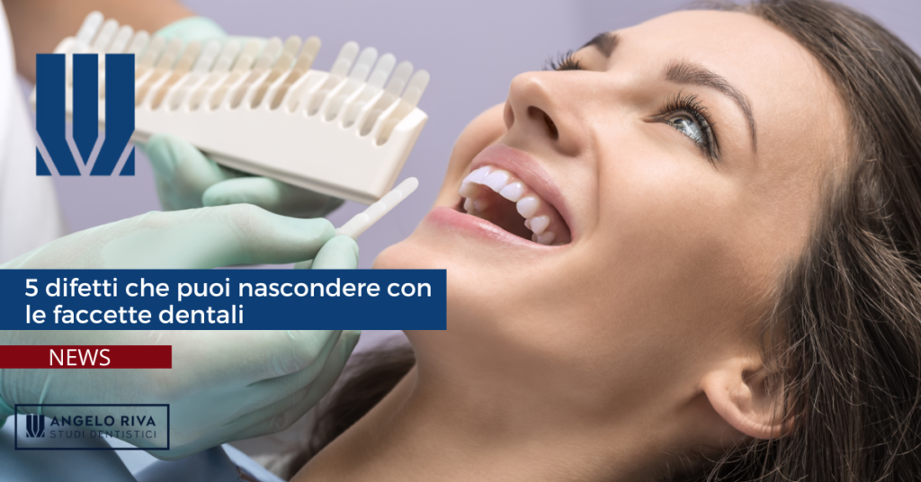 faccette dentali